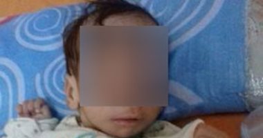 أب من كفر الشيخ يناشد الصحة علاج ابنته الرضيعة من كيس كبير يخرج من المخ