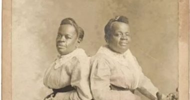 ميلى وكريستين أشهر توأم ملتصق فى القرن الـ 19.. من العبودية لـ الشهرة