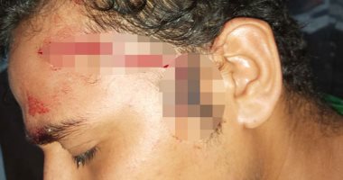 إصابة شاب بـ17 غرزة بعد مشاجرته مع بلطجية لمنعهم من التحرش بفتاة بالغردقة