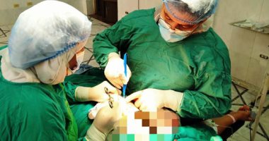 جراحة نادرة لإصلاح عيب خلقى بجبهة طفلة 4 سنوات بمستشفى طنطا التعليمى