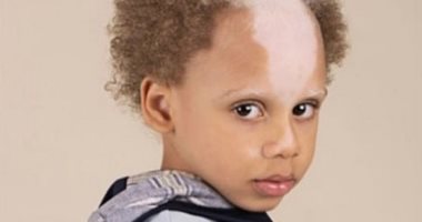طفل برازيلى يصبح عارض أزياء رغم ولادته بمرض وراثى غير لون بشرته.. صور