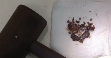 أطباء يزيلون عملة معدنية لروسى بعد 53 عاما من وضعها بأنفه