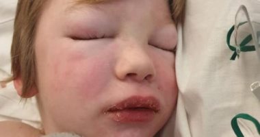 إصابة طفل بريطانى بمرض نادر وفقدان للذاكرة بعد تعافيه من فيروس كورونا