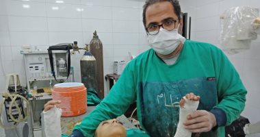أول عملية جراحية بجامعة المنيا لإصلاح الطرفيين العلويين لطفل مصاب بالعظم الزجاجى