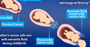 إصابة طفلين بالسرطان إثر استنشاق ورم خبيث بعنق الرحم من الأم أثناء الولادة