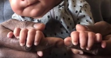 تفاعل كبير مع فيديو "تيك توك" لطفلة بريطانية مولودة بـ12 إصبعا فى يديها