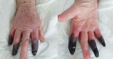 بتر أصابع امرأة إيطالية بعد تسبب أعراض غريبة لكورونا في الغرغرينا