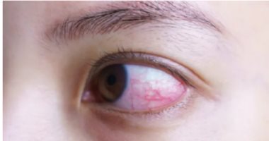 دراسة تؤكد ضرورة فحوصات العين لمرضى كورونا لعلاج التشوهات المحتملة