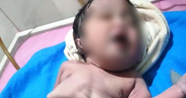 طبيب يكشف تفاصيل ولادة طفل بدون أمعاء بالأقصر.. ويؤكد: زواج الأقارب السبب