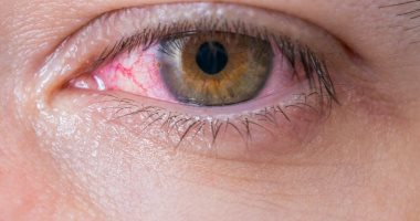 لماذا تصاب بالتهاب ملتحمة العين وما أبرز أعراضها وأنواعها؟