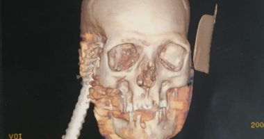 فريق طبى بجامعة أسيوط ينجح فى استخراج سيخ حديد من جمجمة شاب ثلاثينى