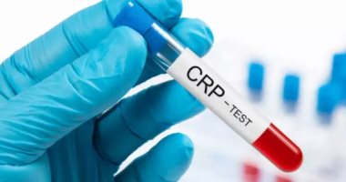 ما هو تحليل CRP وكيف يساعد مرضى كورونا؟