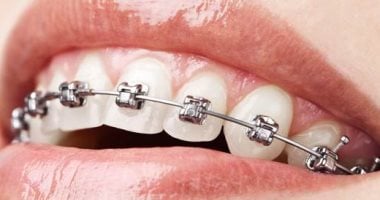 ما سبب الفجوات بين الأسنان؟ تعرف على العلاج والوقاية