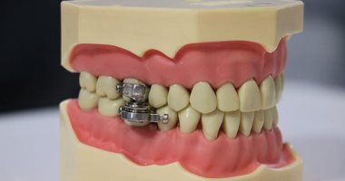  علماء يطورون "قفل أسنان" للمساعدة فى إنقاص الوزن