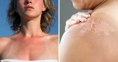 5 نصائح لحماية بشرتك من حروق الشمس في الصيف