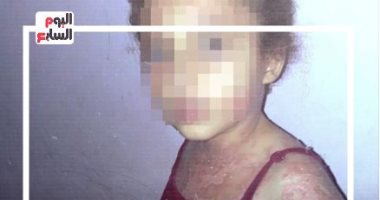 الرئيس السيسى يتكفل بعلاج طفلة من غزة تعانى مرضا جلديا خطيرا.. فيديو