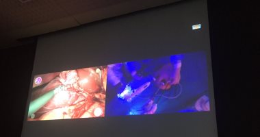 جامعة عين شمس تبدأ إجراء أول جراحة روبوتية باستخدام الإنسان الآلى