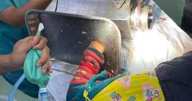 أطباء بسوهاج يعيدون يد طفلة 8 سنوات لطبيعتها بعد دخولها فى مفرمة لحوم