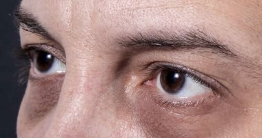 دليلك لتحديد نوع هالات العين وكيفية علاجها.. استخدمى كمادات باردة