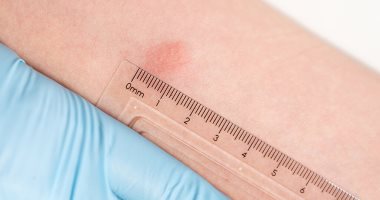 اختبار مانتو للجلد.. أهم طرق تشخيص مرض السل