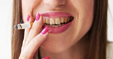 5 أضرار تصيب لثتك وأسنانك بسبب التدخين.. أبرزها سرطان الفم