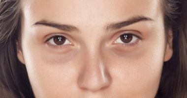 8 نصائح ووصفات طبيعية للتخلص من الهالات السوداء تحت العين 