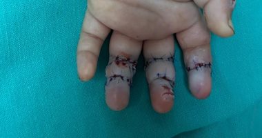 إنقاذ يد طفلة من البتر فى جراحة ناجحة بأحد المستشفيات فى الغربية