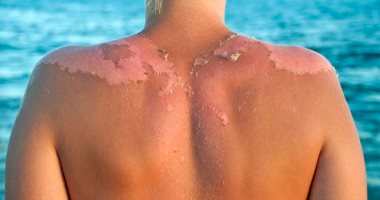 وصفات طبيعية للتخلص من تقشر الجلد بسبب المصيف