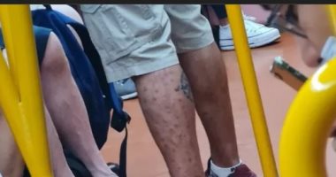 طفح جلدى يثير الفزع بين ركاب مترو فى إسبانيا ..صور 
