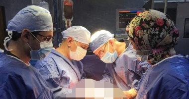 فريق جراحى ببنها الجامعى يستأصل ورما وزنه 12.5 كيلو جرام من صدر مريض عمره 60 عاما