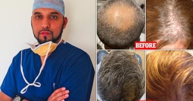 جراح بريطانى يكشف علاقة كورونا بزيادة حالات تساقط الشعر ويلجأ لتقنيات علاج حديثة