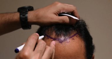 4300 دولار وموت مبكر.. عملية "زراعة شعر" تنتهى بمأساة فى الهند (فيديو)