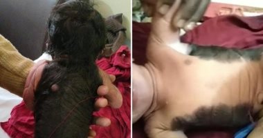 طفل هندى يولد بجسد مغطى نصفه بالشعر وحالته تثير الجدل.. صور  