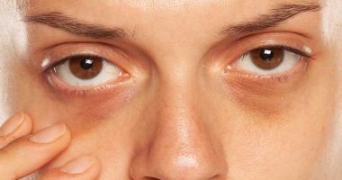 وصفات طبيعية لعلاج الهالات السوداء تحت العين