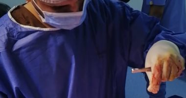 تركيب أول قسطرة مستديمة لمريض غسيل كلوى بمستشفى السنبلاوين العام بالدقهلية