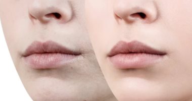 وصفات طبيعية لتفتيح منطقة حول الفم.. للحصول على بشرة موحدة اللون