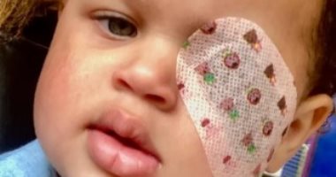 طفلة أمريكية تفقد عينها اليسرى بعد تشخيصها بالخطأ بمرض الأكزيما  