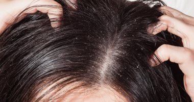 وصفات طبيعية للتخلص من قشرة الشعر .. أبرزها خل التفاح وبذور الحلبة