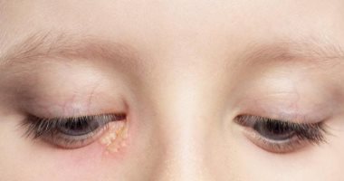الهربس والتهابات العين.. اعرف الرابط بينهما وأهم الأعراض