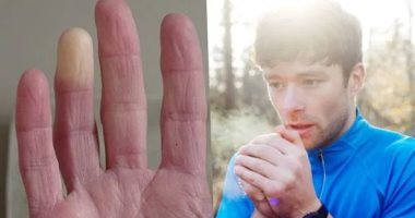 "رينود" مرض يصيب أصابع اليدين والقدمين بسبب البرد.. الأعراض والعلاج 
