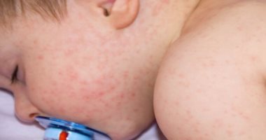 علامات جلدية تظهر على الرضيع المصاب بحساسية اللبن