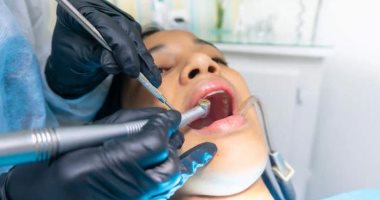 سيدة أمريكية تقاضى طبيب أسنان أجرى لها 32 عملية فى جلسة واحدة