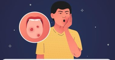 هيئة الدواء تكشف 3 طرق مهمة لعلاج قرح الفم
