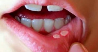 اعرفى أعراض فطريات الفم عند الأطفال وطرق الوقاية.. استشاري توضح