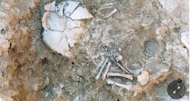 حمض نووى لعظام أطفال يكشف إصابتهم بمتلازمة دوان منذ 5500 عام