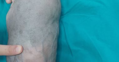 للمرة الأولى بجامعة الإسكندرية.. نجاح عملية نادرة لفصل توأم ملتصق من الرأس توأم ملتصق