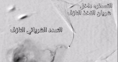 إنجاز طبى جديد لعلاج شرايين الفخذ النازفة بوحدة الأشعة التداخلية بسوهاج الجامعى