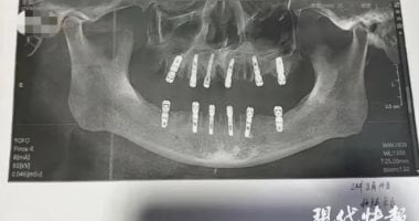 صينى يخلع 23 سناً ويزرع 12آخرين فى نفس اليوم ويموت بعد 13يوماً