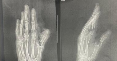 فريق طبى ينجح فى إعادة أصابع شاب بعد بترها بمستشفى جامعة أسوان