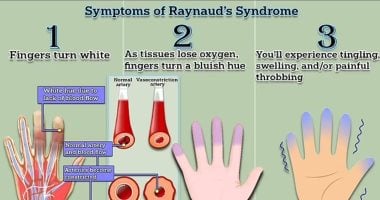 اختبار مدته دقيقة يكشف إذا كنت تعاني من مرض برودة الأطراف "رينود"
